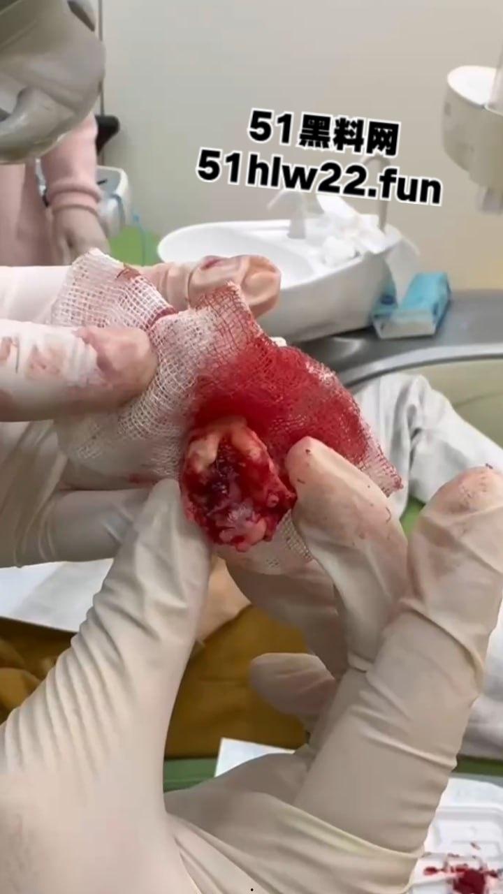 口腔医院逆天操作，客人拔智齿结果医生不分青红皂白直接大力出奇迹， 把上颌骨拔断撤了下来！-1