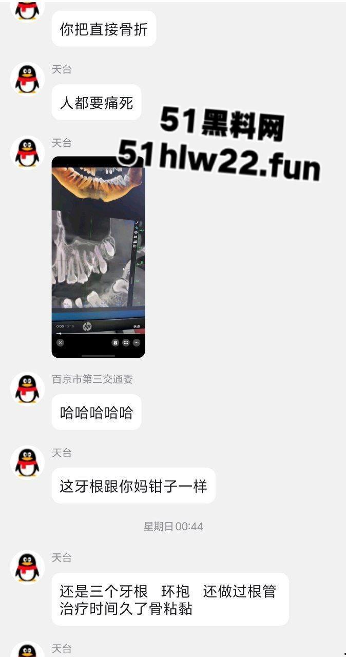 口腔医院逆天操作，客人拔智齿结果医生不分青红皂白直接大力出奇迹， 把上颌骨拔断撤了下来！-3