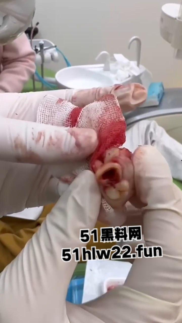 口腔医院逆天操作，客人拔智齿结果医生不分青红皂白直接大力出奇迹， 把上颌骨拔断撤了下来！-5