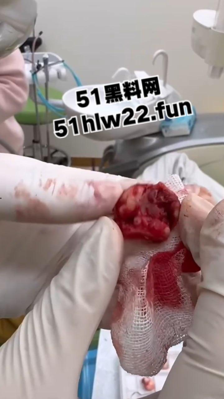 口腔医院逆天操作，客人拔智齿结果医生不分青红皂白直接大力出奇迹， 把上颌骨拔断撤了下来！-6