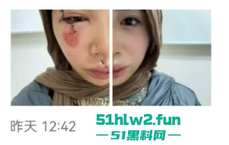 卖惨惯犯纹身妹,骑电瓶车出车祸惨遭破相朋友圈无奈卖身求钱就医,骚货的卖身已成习惯。-6