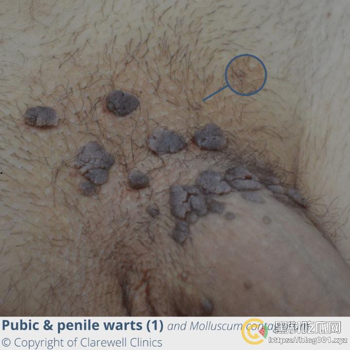 性病篇  谨慎观看！瓜友们出门在外 一定得洁身自爱 世界上没有后悔药  安全第一！！！ （二）-7