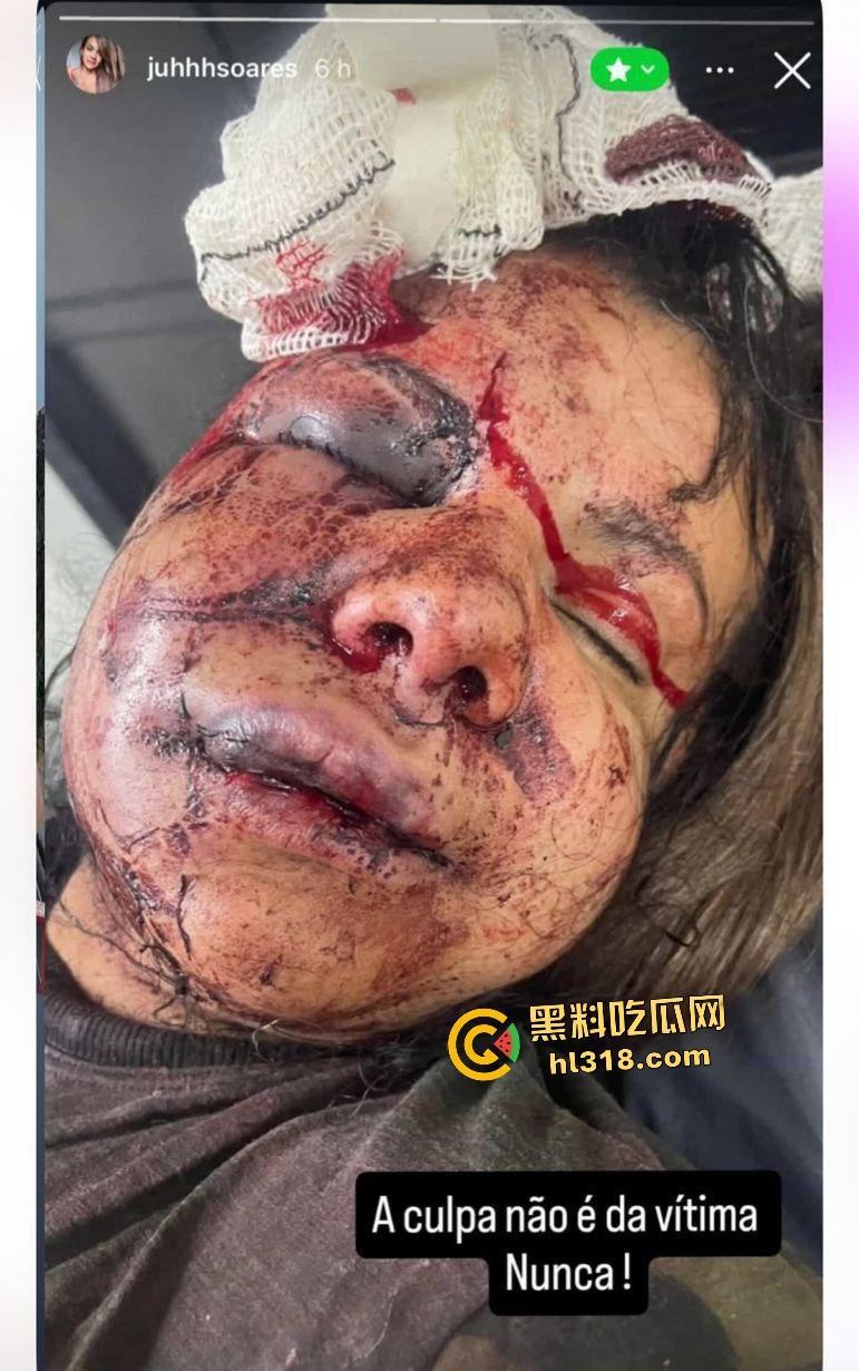 巴西前篮球明星伊戈尔·卡布拉尔化身暴徒!电梯内狂殴女友60拳,面骨粉碎血溅当场!-8