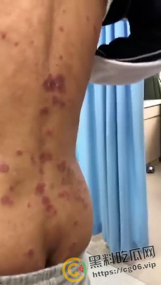 初三学生化身毒王 梅毒三期 艾滋 浑身腐烂 牛子流脓 还说自己没有过性生活 检查现场视频曝光-3