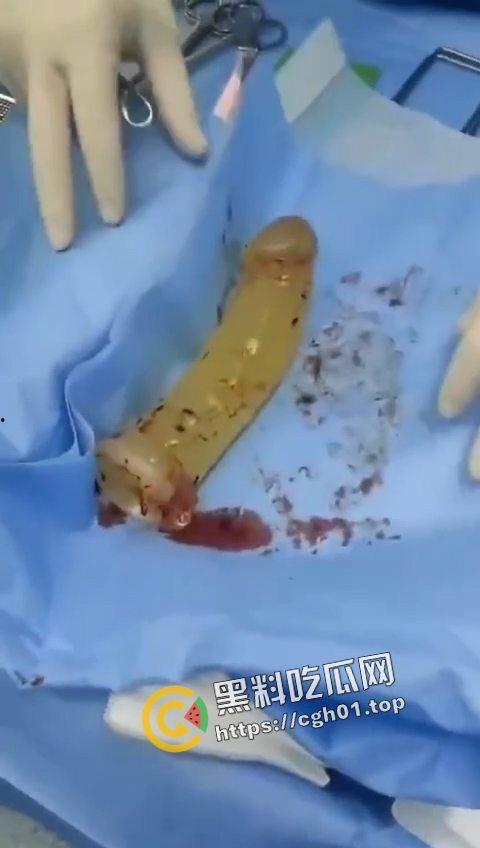 活久见!超大假阳具塞进体内拿不出来只能做手术 你们男同玩的都这么狠吗-4