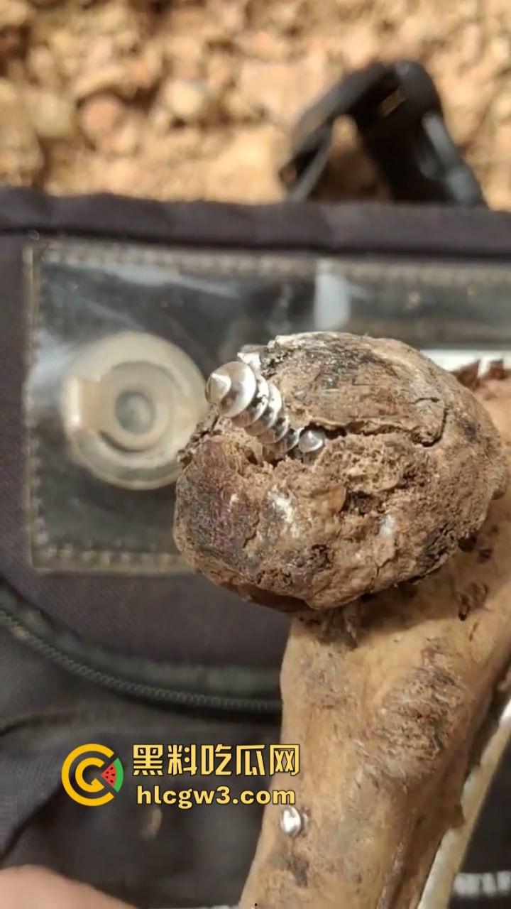 大妈去世后尸骨爆出惊人秘密 广西玉林大化骨科医院恐怖接骨手术让人震惊-8