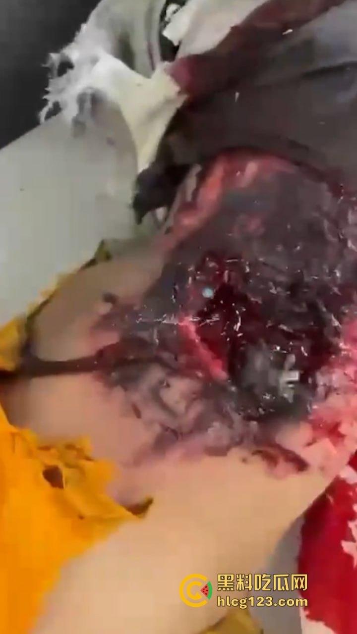 黎巴嫩发生大规模BP机爆炸事件 4000多人受伤 11人死亡 以色列远程植爆-8