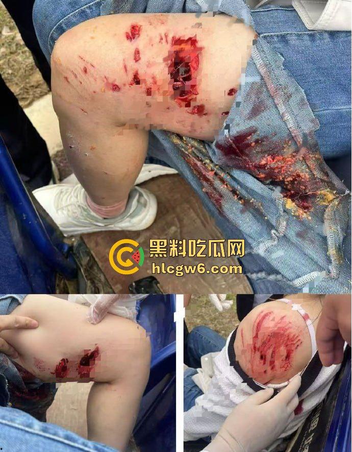 江西赣州母女在公园散步被四条野狗攻击撕咬，扯下来的肉被吃掉，暴露性伤口可以塞进一只手-3